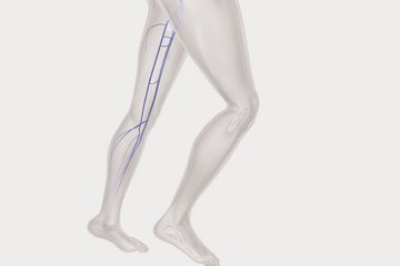 biolitec_KV_Phlebology_LQ