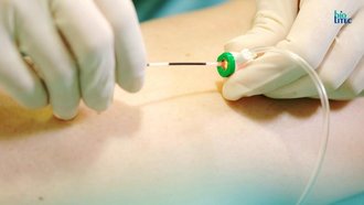 ELVeS__Radial__2ring_fiber_during_treatment_@biolitec