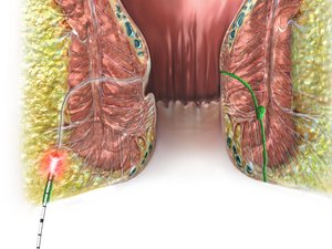 Behandlung_einer_Analfistel_mit_Laser_@biolitec_Zuschnitt_NEU_Balken