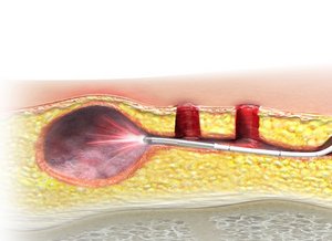 Behandlung_einer_Steißbeinfistel_mit_der_SiLaC_-Methode_der_biolitec_____biolitec___800x600
