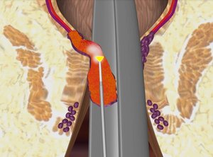 LHP_2_-_Laserfaser_der_biolitec_während_der_Behandlung_einer_Hämorrhoide_von_innen____biolitec___813x599