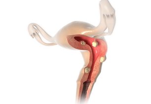 uterus-befund-myom-polyp-160916