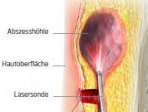 Illu_Steißbeinfistel_mit_Laser_web