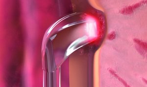 Prostatabehandlung_mit_XCAVATOR_-Faser_von_biolitec__Ausschnitt_800X450