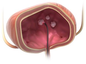 Entfernung_eines_Blasenkarzinoms_mit_einem_flexiblen_Zystoskop_und_der_Bare_fiber_der_biolitec__high_res_800px