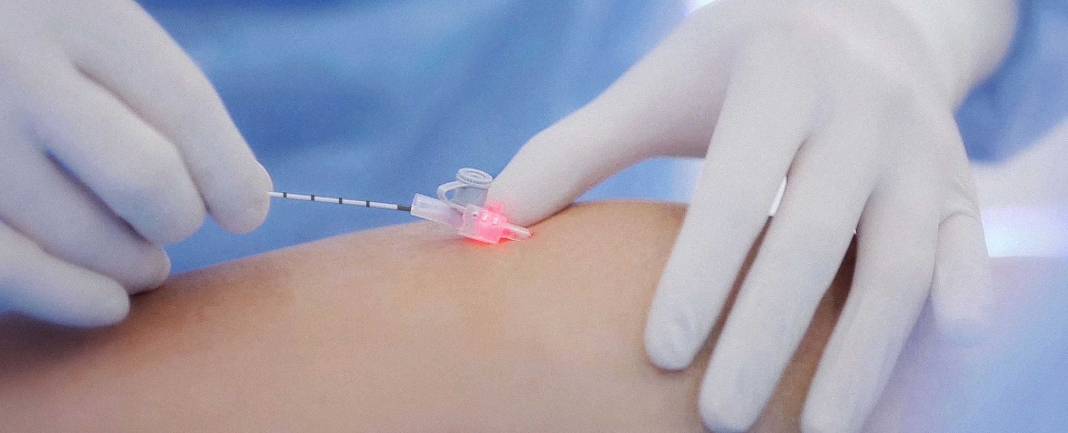 ELVeS_Radial_2ring-Faser_in_der_Kanuele_am_Bein_Zuschnitt